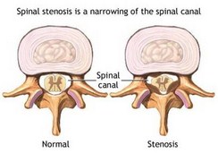 spinal stenosis--Beverly Hills chiropractic